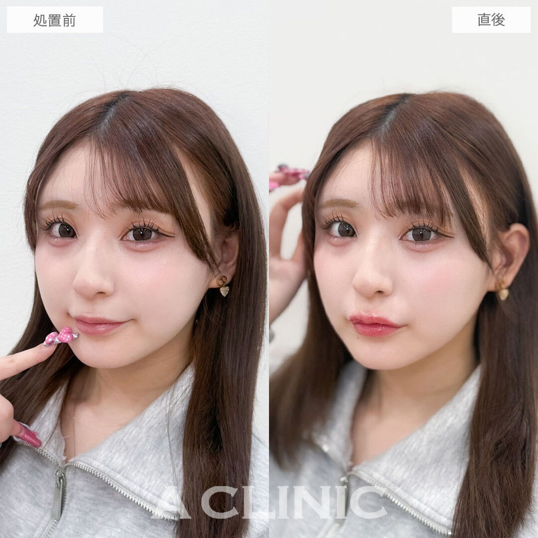 スマイルリップで唇の左右差なくして可愛くボリュームアップ！こちら処置前と直後の症例です(20代女性)