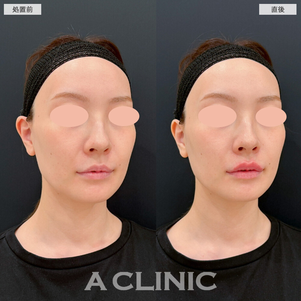 リップヒアルロン酸注入でセクシーなM字リップをGET！こちら処置前と直後の症例です(30代女性)