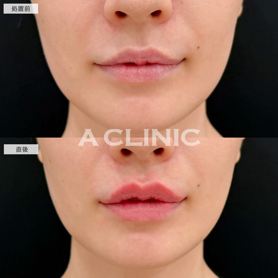 リップヒアルロン酸注入でセクシーなM字リップをGET！こちら処置前と直後の症例です(30代女性)