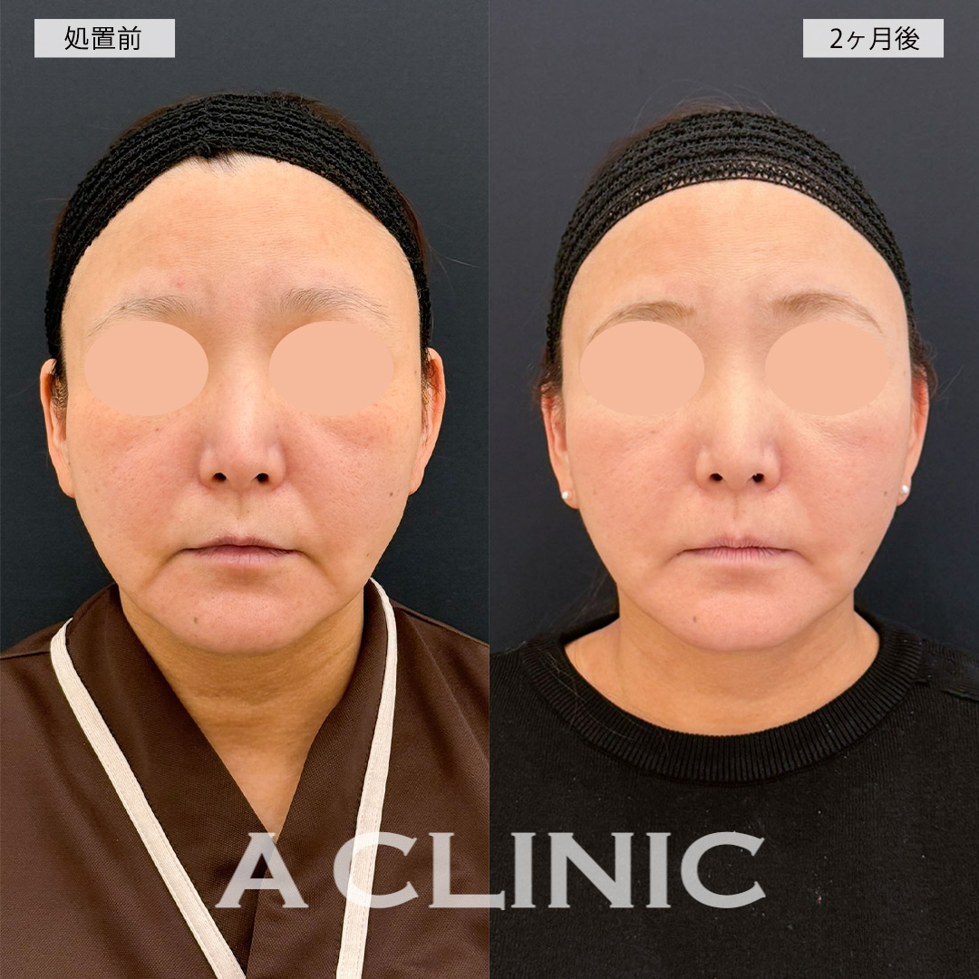 A式美肌たるみ切開でマリオネットラインがかなり薄くなり若返った印象に！こちら処置前と2ヶ月後の症例です(50代女性)