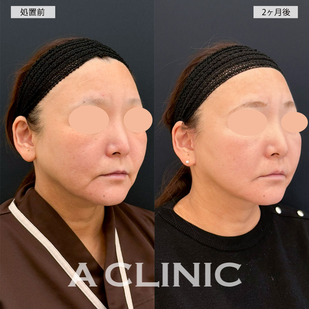 A式美肌たるみ切開でマリオネットラインがかなり薄くなり若返った印象に！こちら処置前と2ヶ月後の症例です(50代女性)