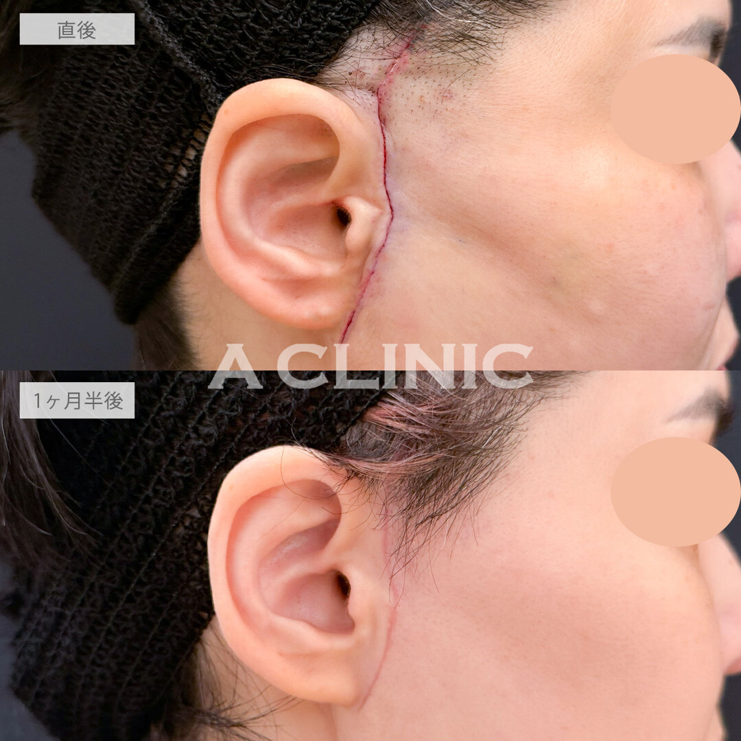 【直後の傷跡あり】A式ナゾラリフトはたるみが気になってきたお顔を改善させます！こちら処置前と1か月半後の症例です(40代女性)