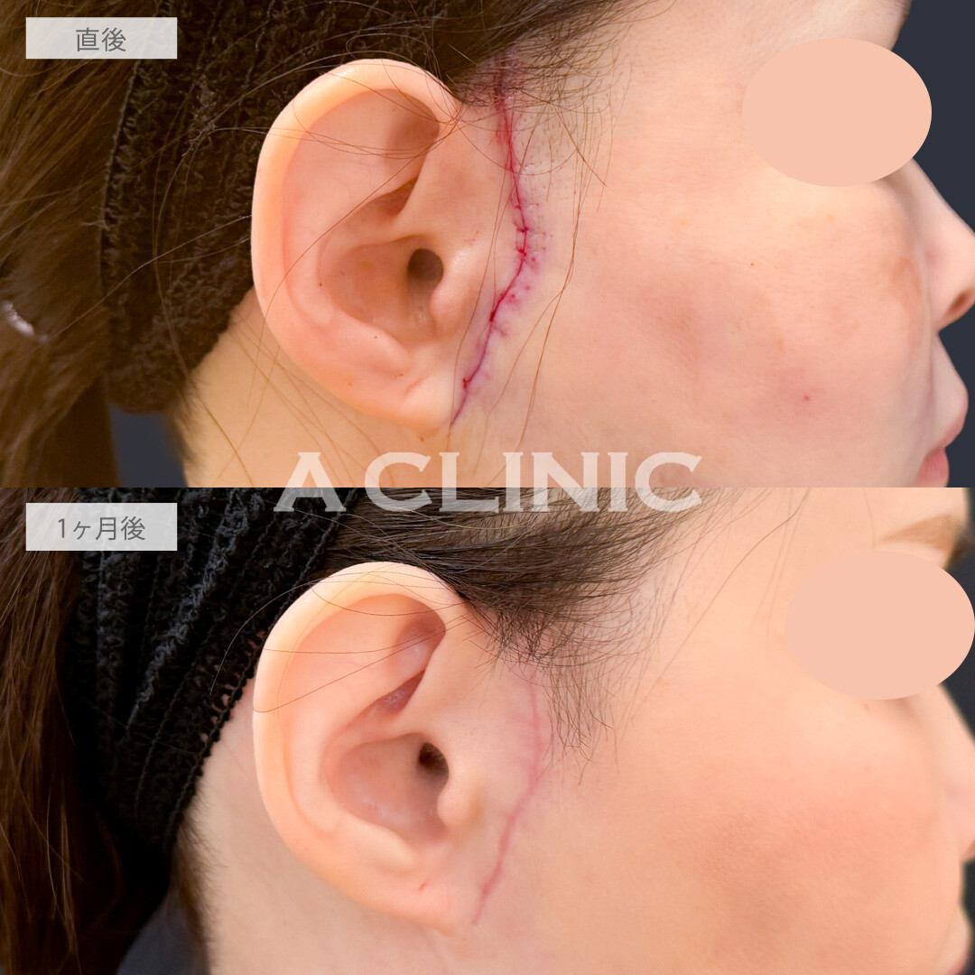 【直後の傷跡あり】A式ナゾラリフトでたるみの引き上げとほうれい線周りの脂肪を同時にケア！こちら処置前と1か月後の症例です(50代女性)