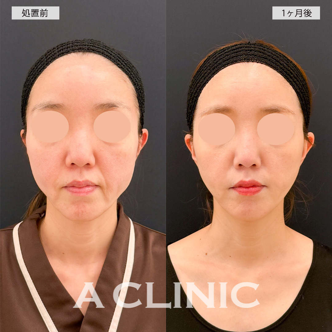 【直後の傷跡あり】A式美肌たるみ切開でフェイスラインのもたつきが改善され若返り！こちら処置前から1ヶ月後の症例です(40代女性)