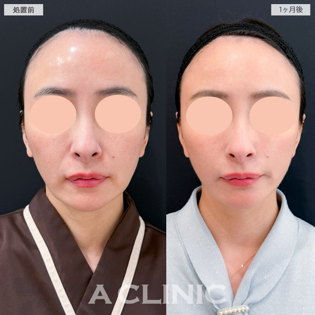 ナゾラビアルファット除去術とA式美肌たるみ切開でほうれい線とフェイスラインのたるみが同時に解消できました！処置前と1ヶ月後の症例です(40代女性)