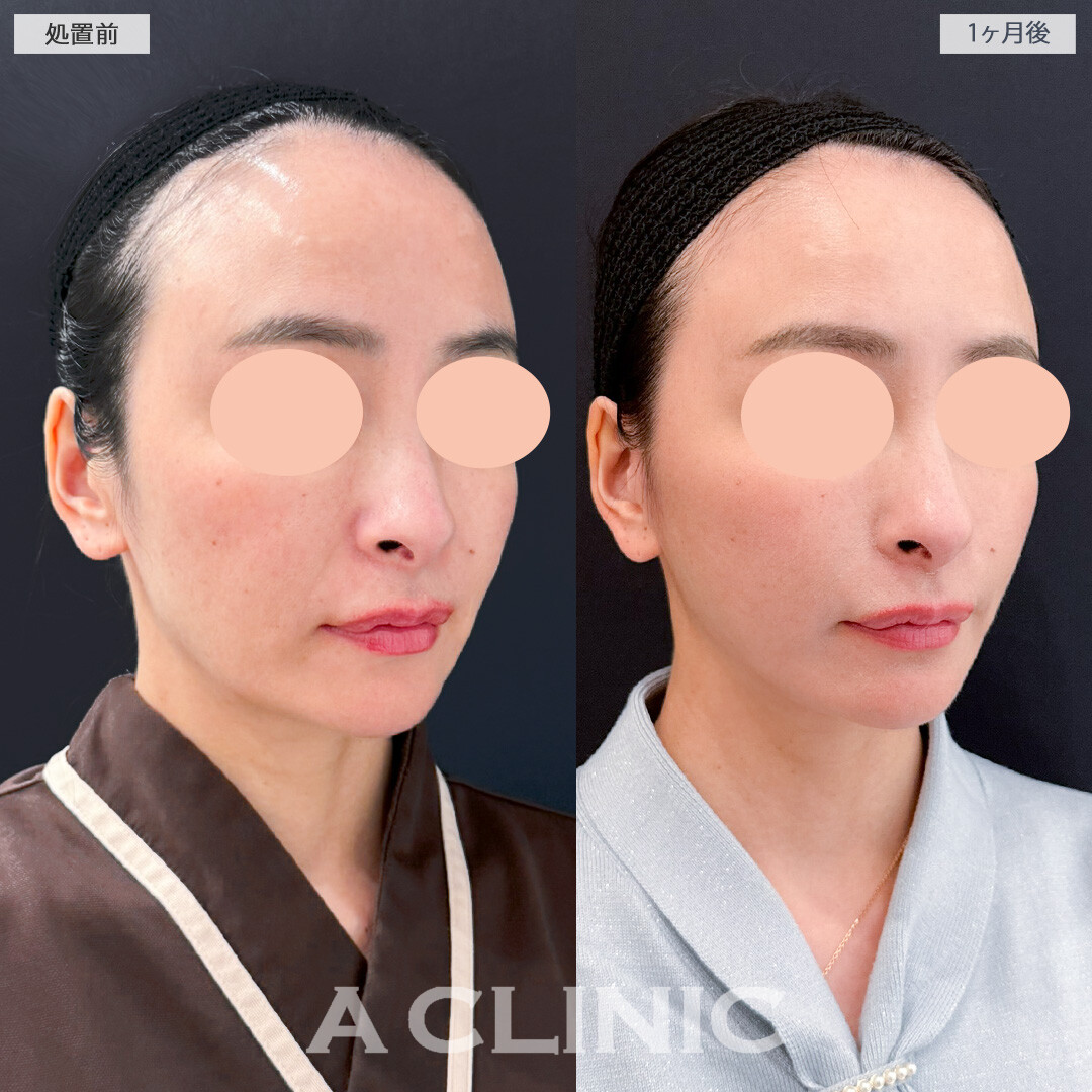 ナゾラビアルファット除去術とA式美肌たるみ切開でほうれい線とフェイスラインのたるみが同時に解消できました！処置前と1ヶ月後の症例です(40代女性)