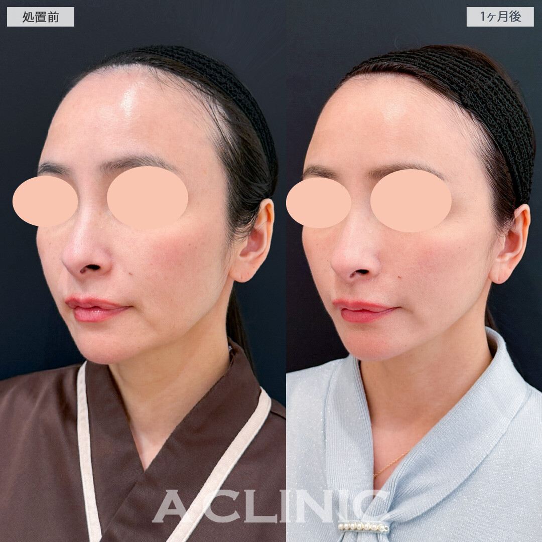 ナゾラビアルファット除去術とA式美肌たるみ切開でほうれい線とフェイスラインのたるみが同時に解消できました！処置前と1ヶ月後の症例です(40代女性)