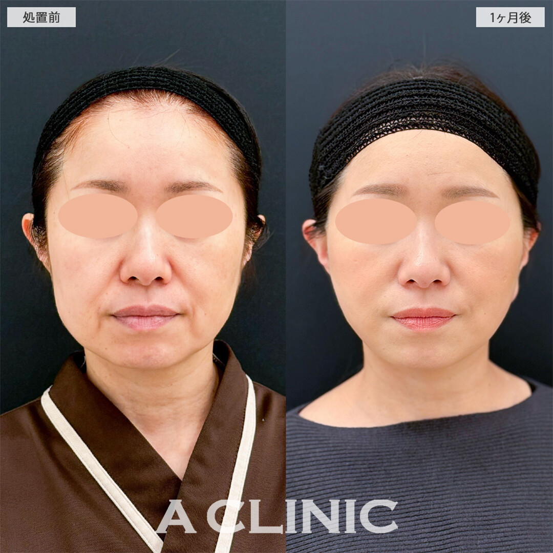 A式美肌たるみ切開で念願の若返りに成功しました！こちら処置前と1ヶ月後の症例です(40代女性)