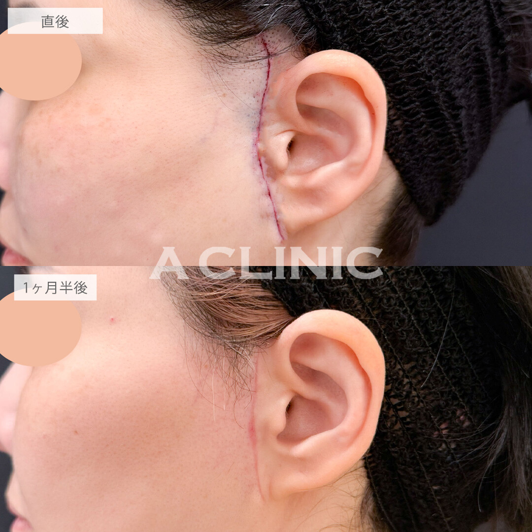 【直後の傷跡あり】A式ナゾラリフトはたるみが気になってきたお顔を改善させます！こちら処置前と1か月半後の症例です(40代女性)