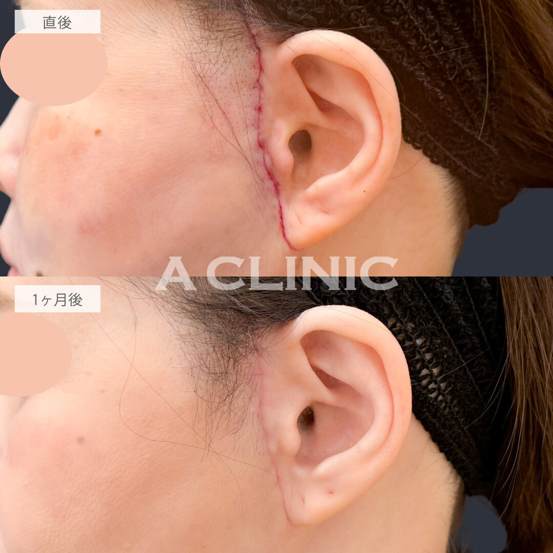 【直後の傷跡あり】A式ナゾラリフトでたるみの引き上げとほうれい線周りの脂肪を同時にケア！こちら処置前と1か月後の症例です(50代女性)