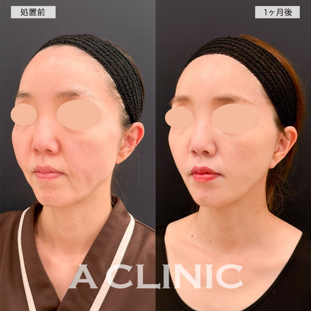 【直後の傷跡あり】A式美肌たるみ切開でフェイスラインのもたつきが改善され若返り！こちら処置前から1ヶ月後の症例です(40代女性)
