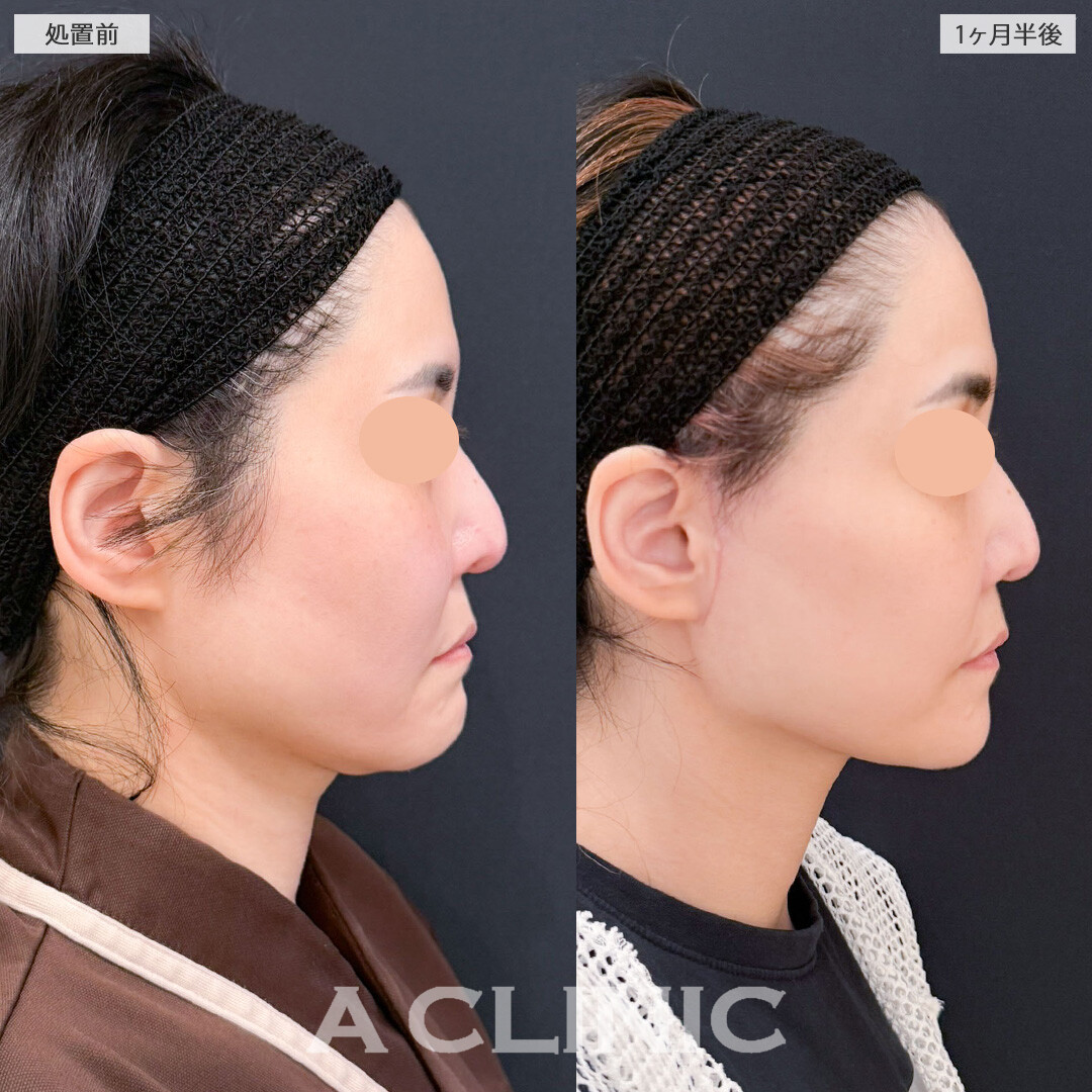 【直後の傷跡あり】A式ナゾラリフトはたるみが気になってきたお顔を改善させます！こちら処置前と1か月半後の症例です(40代女性)