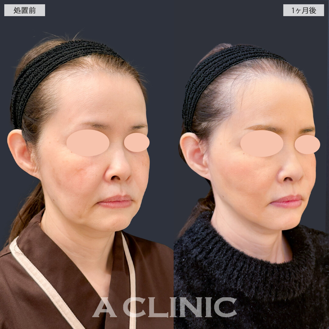 【直後の傷跡あり】A式ナゾラリフトでたるみの引き上げとほうれい線周りの脂肪を同時にケア！こちら処置前と1か月後の症例です(50代女性)