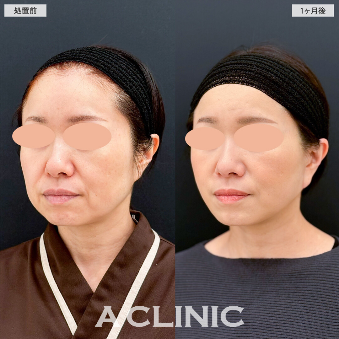 A式美肌たるみ切開で念願の若返りに成功しました！こちら処置前と1ヶ月後の症例です(40代女性)