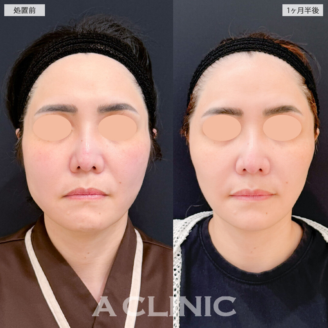 【直後の傷跡あり】A式ナゾラリフトはたるみが気になってきたお顔を改善させます！こちら処置前と1か月半後の症例です(40代女性)