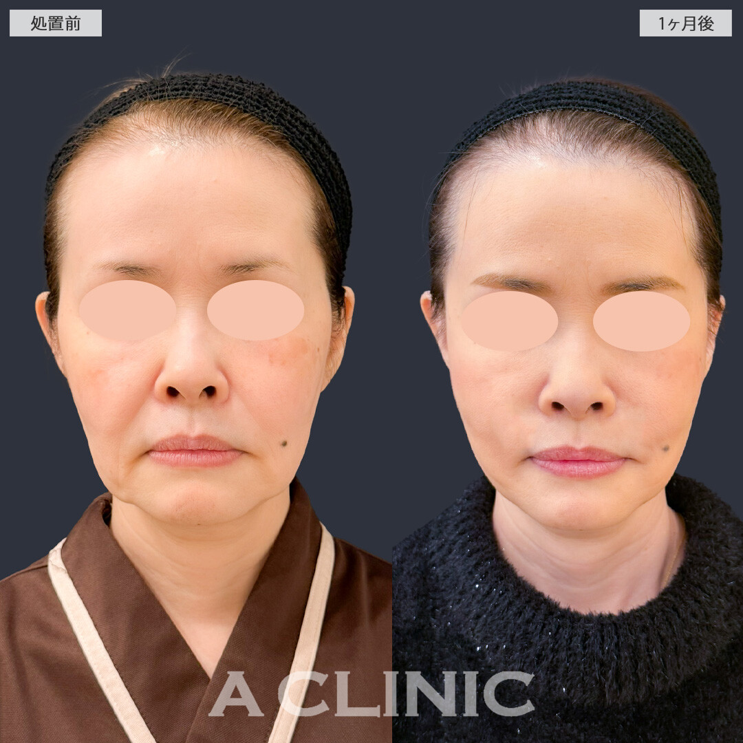 【直後の傷跡あり】A式ナゾラリフトでたるみの引き上げとほうれい線周りの脂肪を同時にケア！こちら処置前と1か月後の症例です(50代女性)