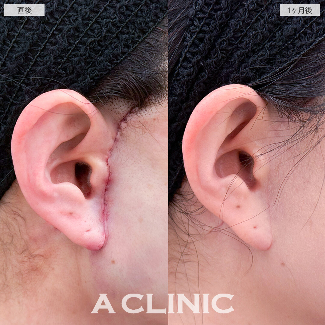 A式美肌たるみ切開で念願の若返りに成功しました！こちら処置前と1ヶ月後の症例です(40代女性)