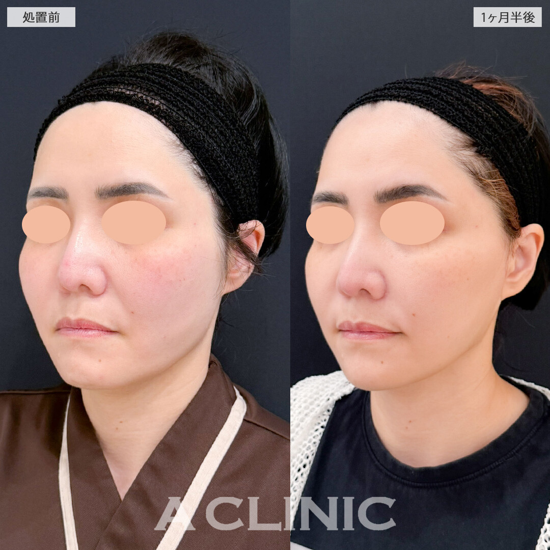 【直後の傷跡あり】A式ナゾラリフトはたるみが気になってきたお顔を改善させます！こちら処置前と1か月半後の症例です(40代女性)