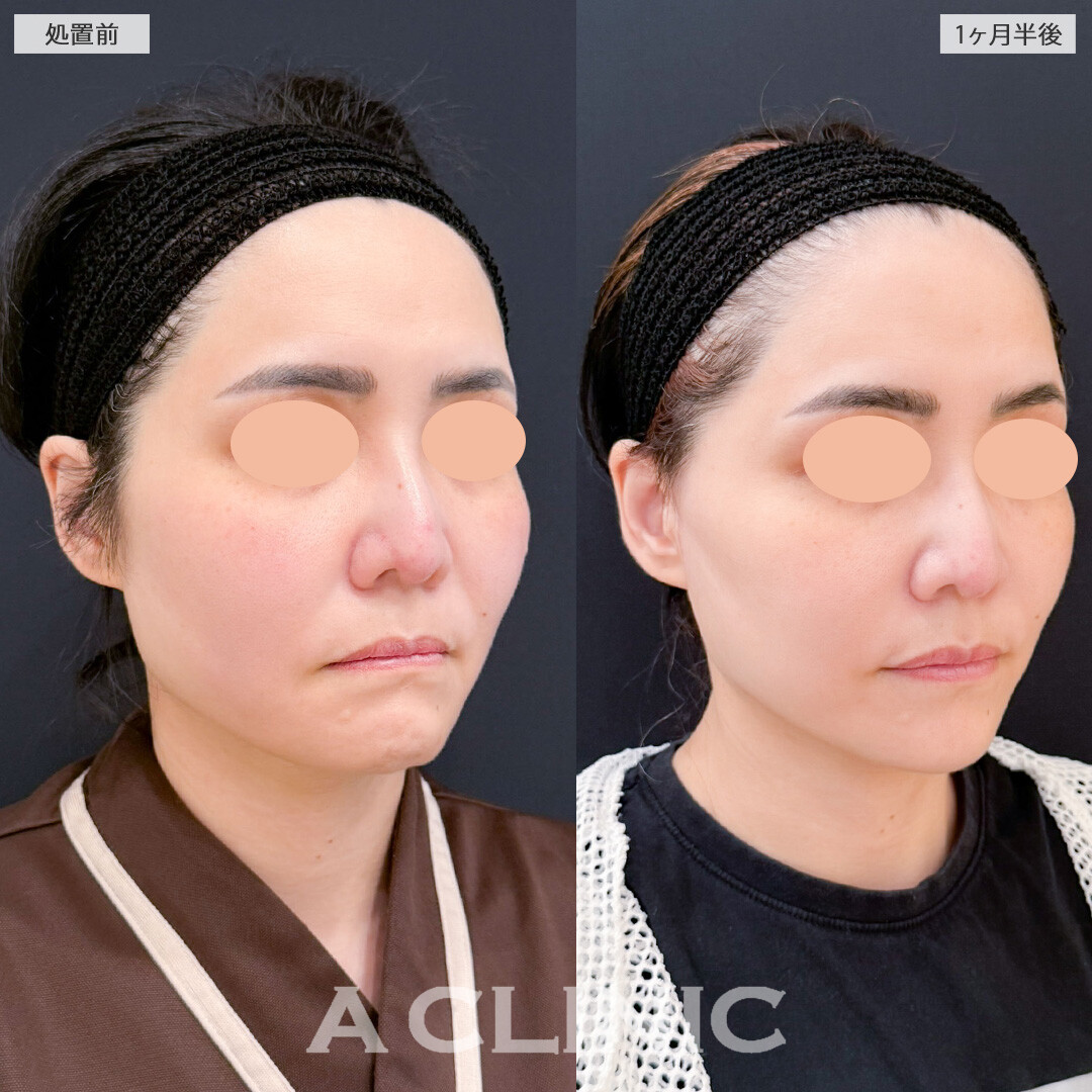 【直後の傷跡あり】A式ナゾラリフトはたるみが気になってきたお顔を改善させます！こちら処置前と1か月半後の症例です(40代女性)
