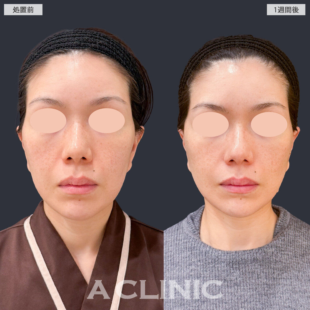 【直後の傷跡あり】A式美肌たるみ切開で若々しいシャープなフェイスラインに！こちら処置前と1週間後の症例です(40代女性)