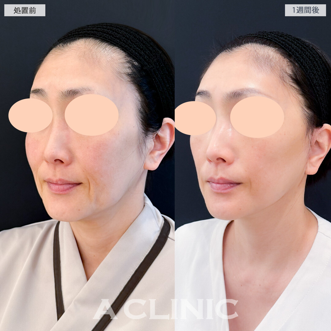 A式美肌たるみ切開でたるみ改善と予防どちらも叶う！処置前と1週間後の症例です(50代女性)