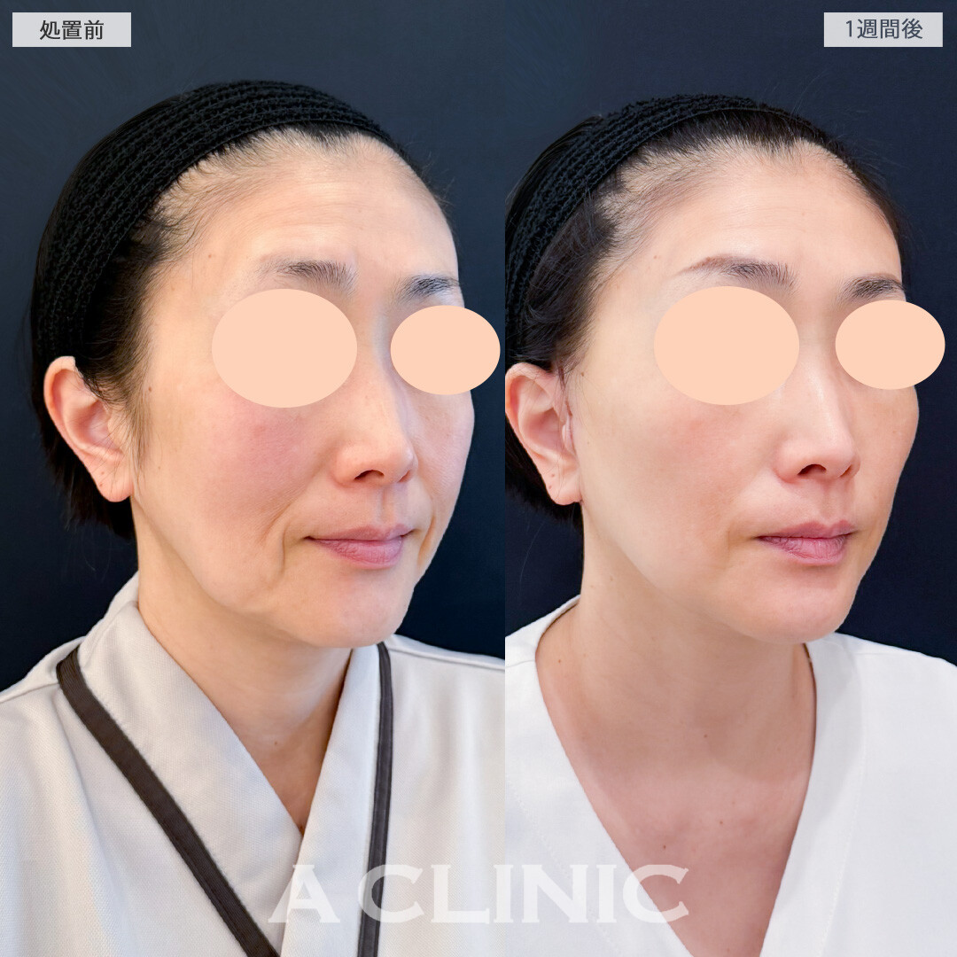 A式美肌たるみ切開でたるみ改善と予防どちらも叶う！処置前と1週間後の症例です(50代女性)