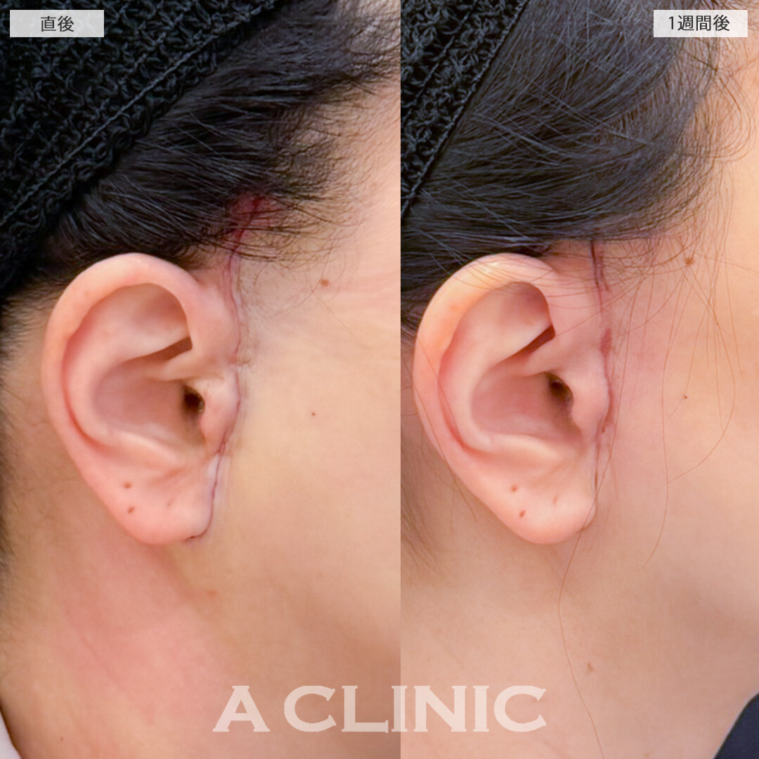 【直後の傷跡あり】A式美肌たるみ切開でたるみ改善と予防どちらも叶う！処置前と1週間後の症例です(50代女性)