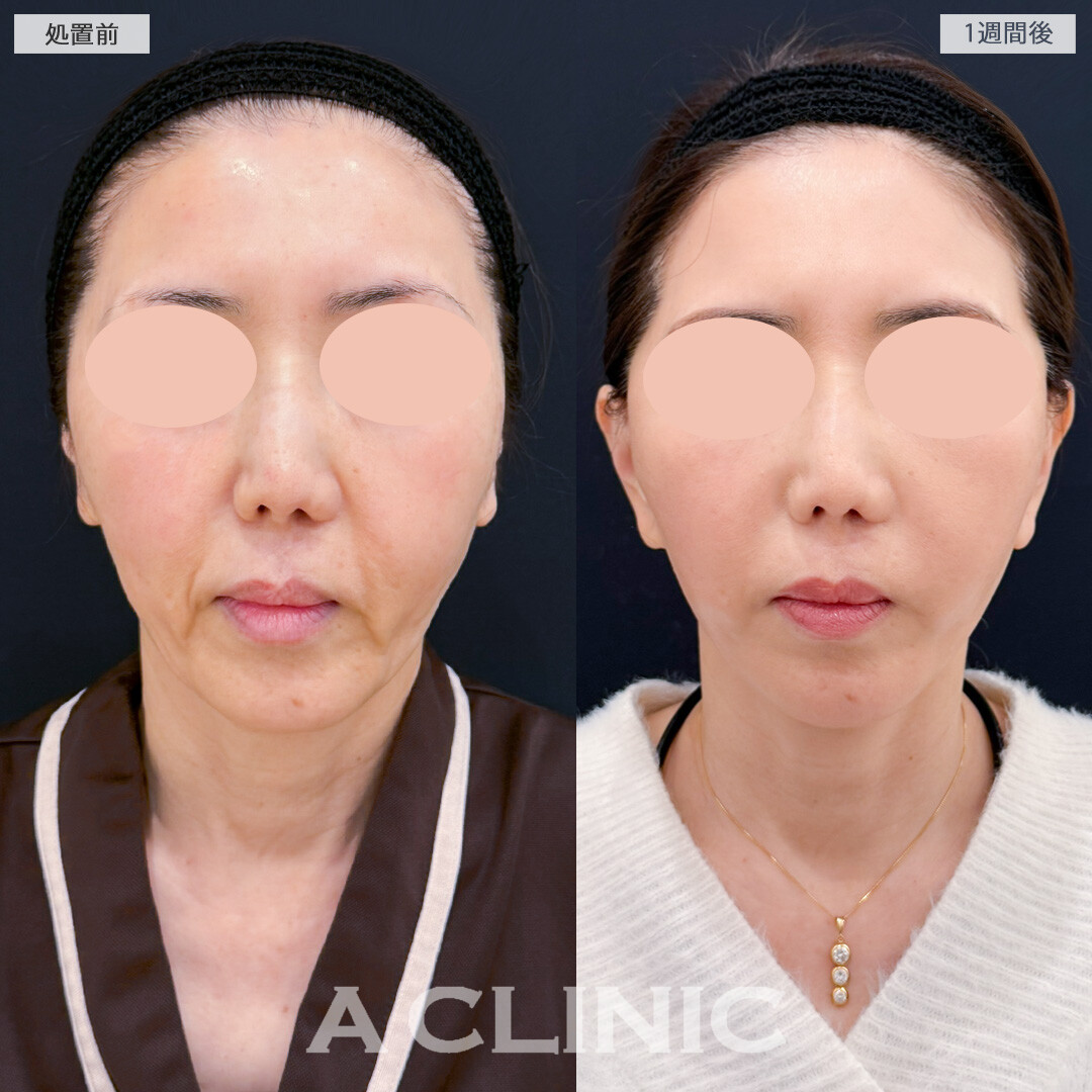 A式美肌たるみ切開でたるみが解消されフェイスラインがスッキリしました！処置前と1週間後の症例です(50代女性)