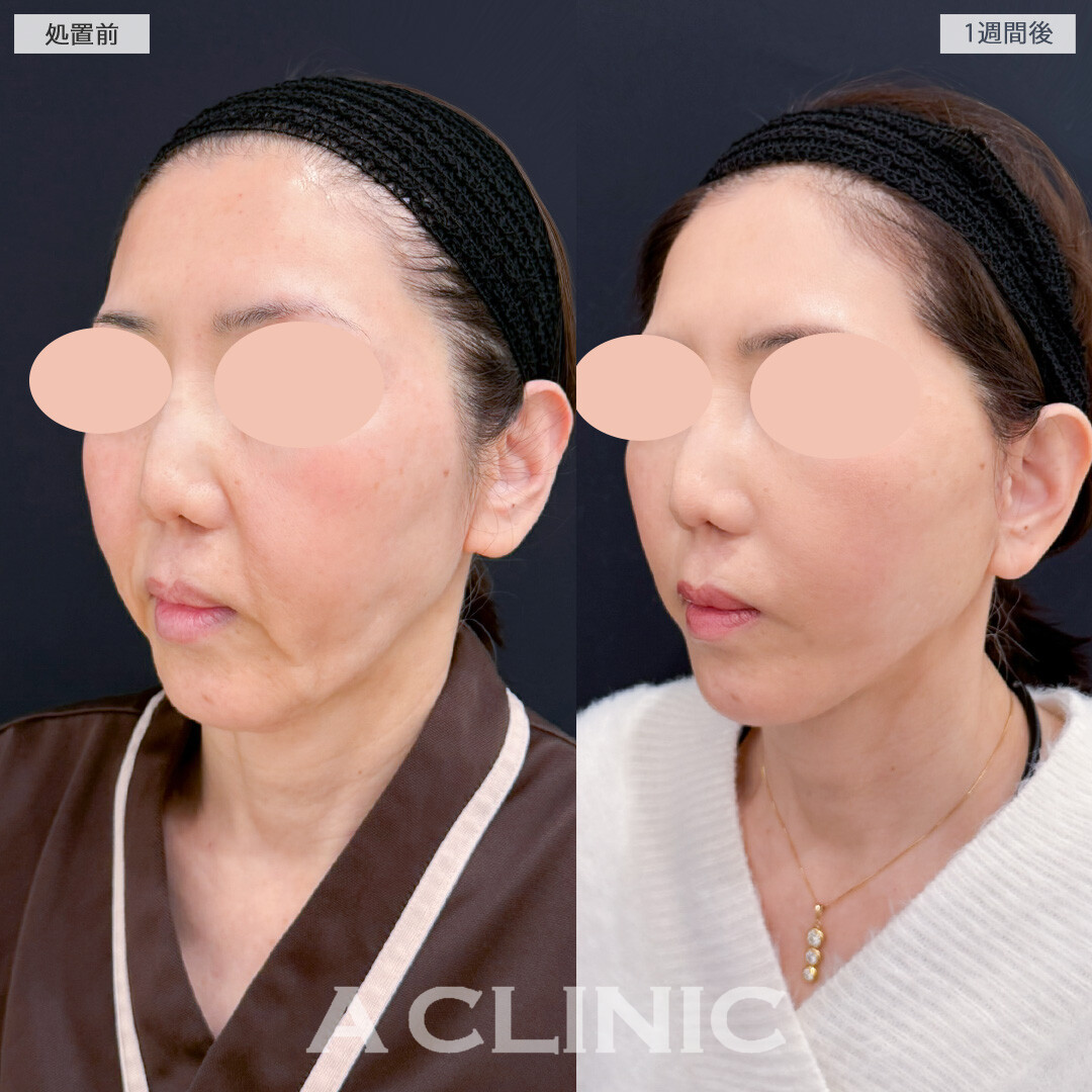 A式美肌たるみ切開でたるみが解消されフェイスラインがスッキリしました！処置前と1週間後の症例です(50代女性)