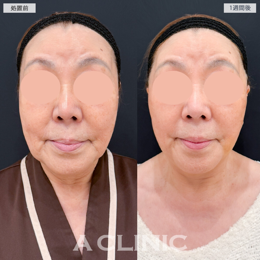 A式美肌たるみ切開とジョールファット除去術で下膨れ顔を解消したるみの目立たないフェイスラインに！処置前と1週間後の症例です(70代女性)