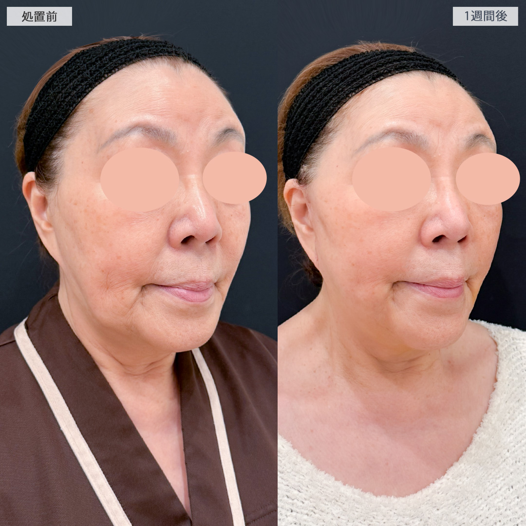 A式美肌たるみ切開とジョールファット除去術で下膨れ顔を解消したるみの目立たないフェイスラインに！処置前と1週間後の症例です(70代女性)
