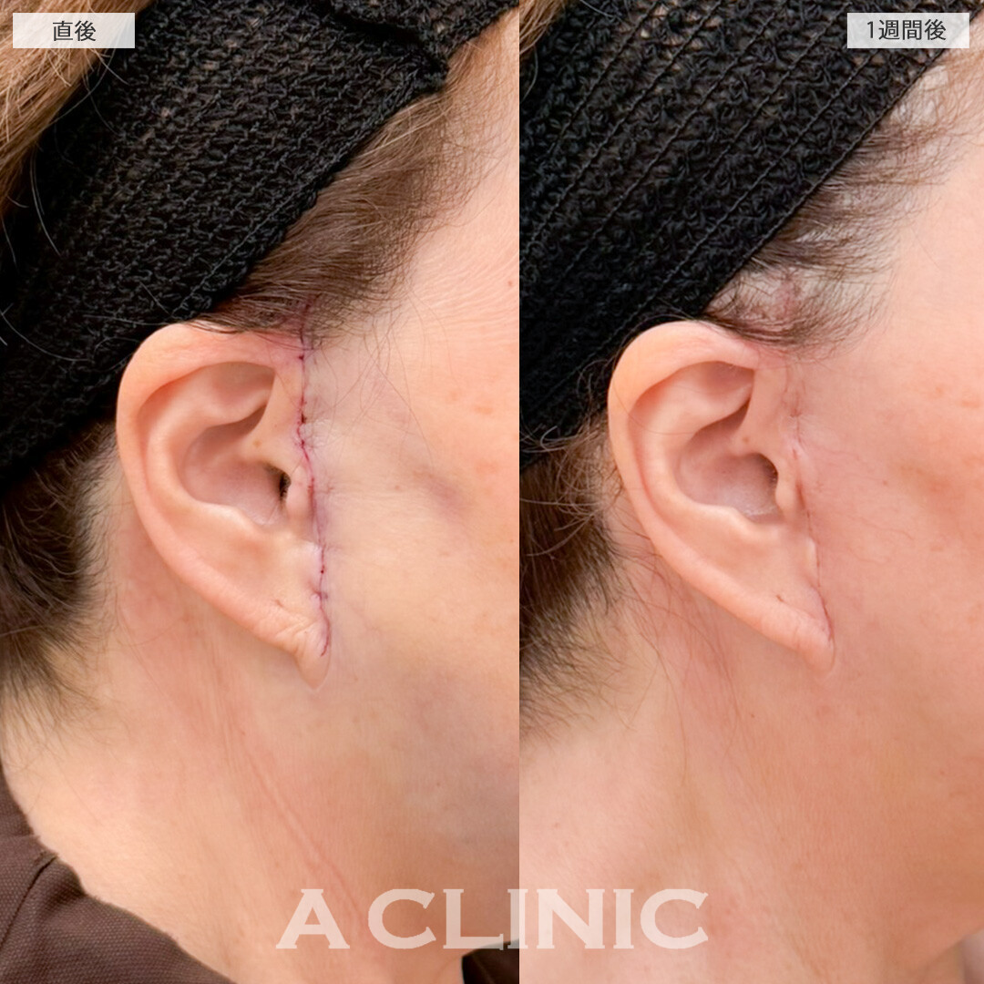 【直後の傷跡あり】A式美肌たるみ切開とジョールファット除去術で下膨れ顔を解消したるみの目立たないフェイスラインに！処置前と1週間後の症例です(70代女性)