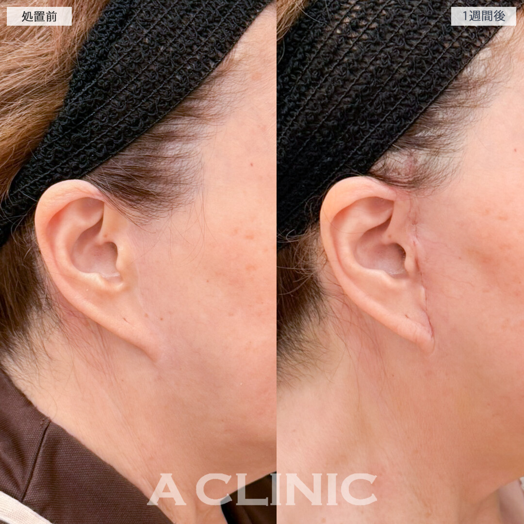 A式美肌たるみ切開とジョールファット除去術で下膨れ顔を解消したるみの目立たないフェイスラインに！処置前と1週間後の症例です(70代女性)