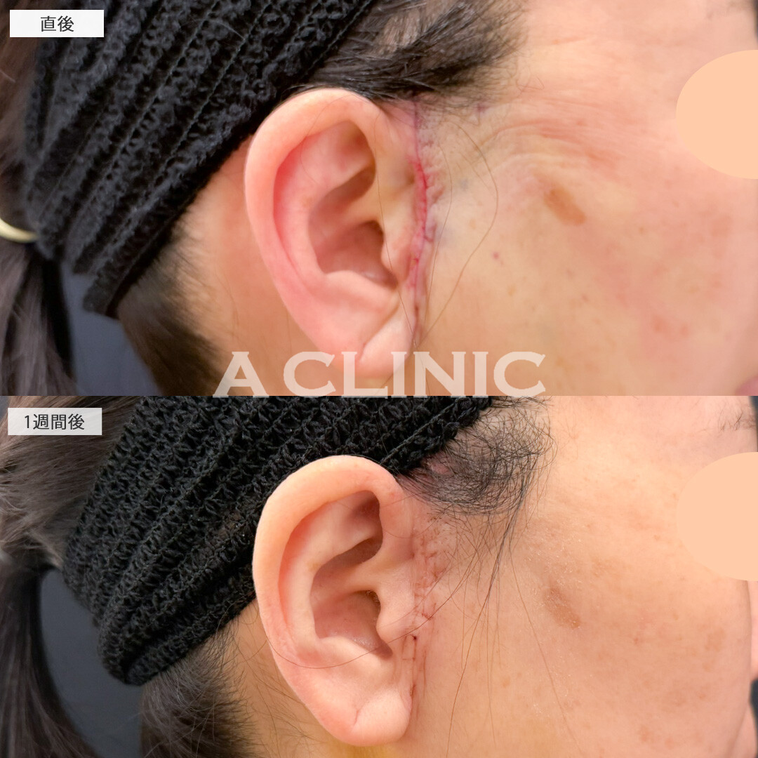 【直後の傷跡あり】A式美肌たるみ切開で年齢の出やすい口横やフェイスラインのもたつきがここまで変わりました！処置前と1週間後の症例です(40代女性)