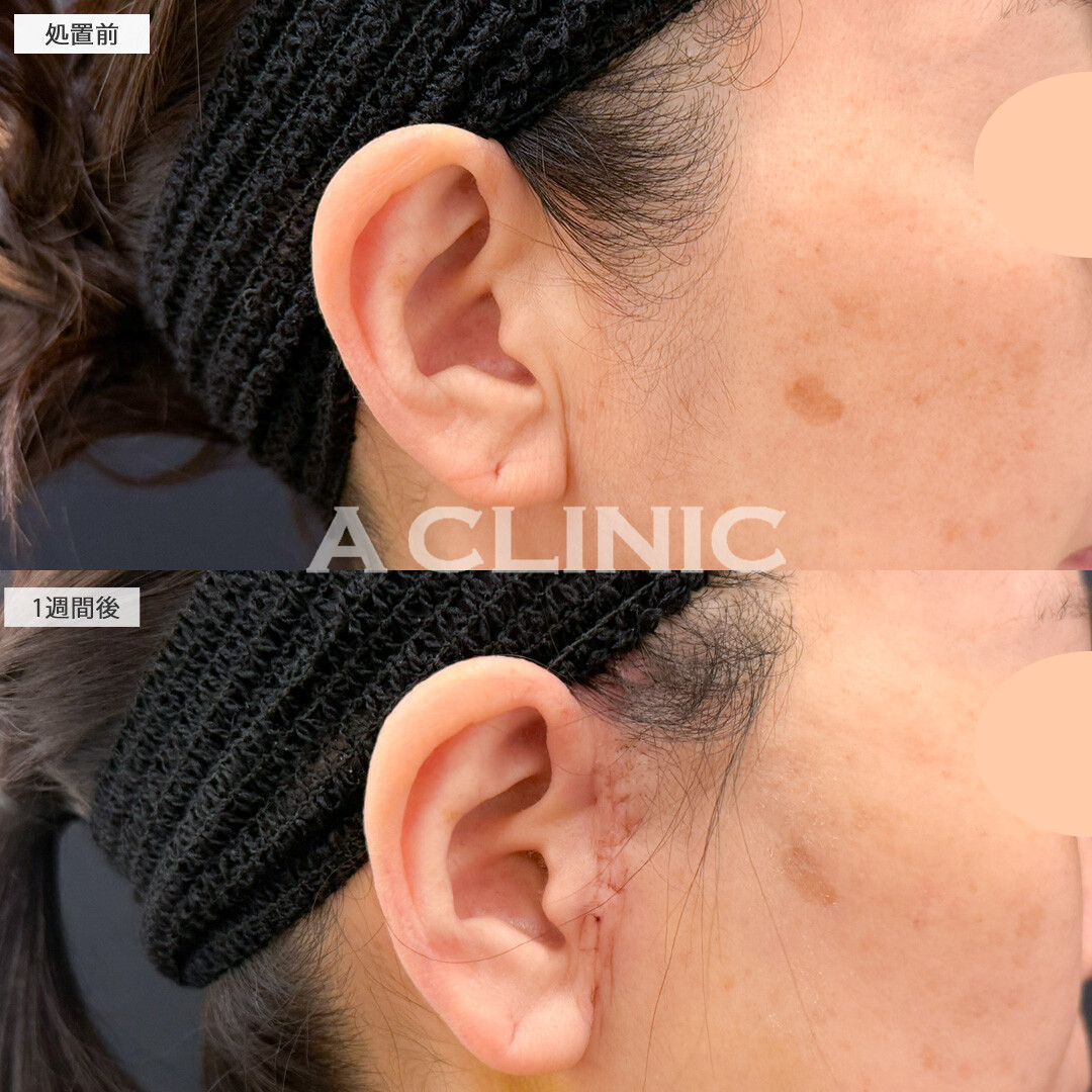 A式美肌たるみ切開で年齢の出やすい口横やフェイスラインのもたつきがここまで変わりました！処置前と1週間後の症例です(40代女性)