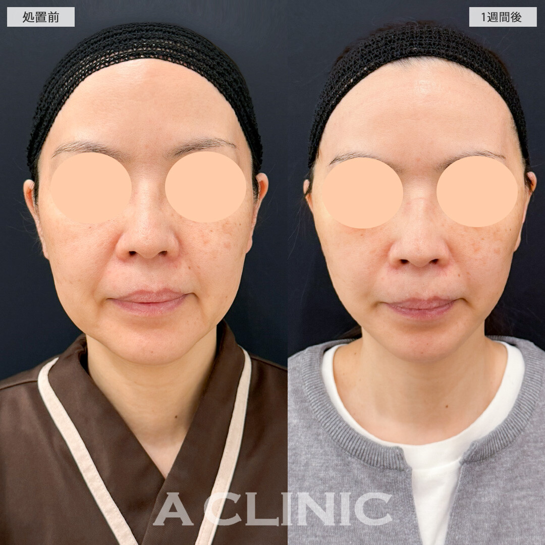 A式美肌たるみ切開で年齢の出やすい口横やフェイスラインのもたつきがここまで変わりました！処置前と1週間後の症例です(40代女性)