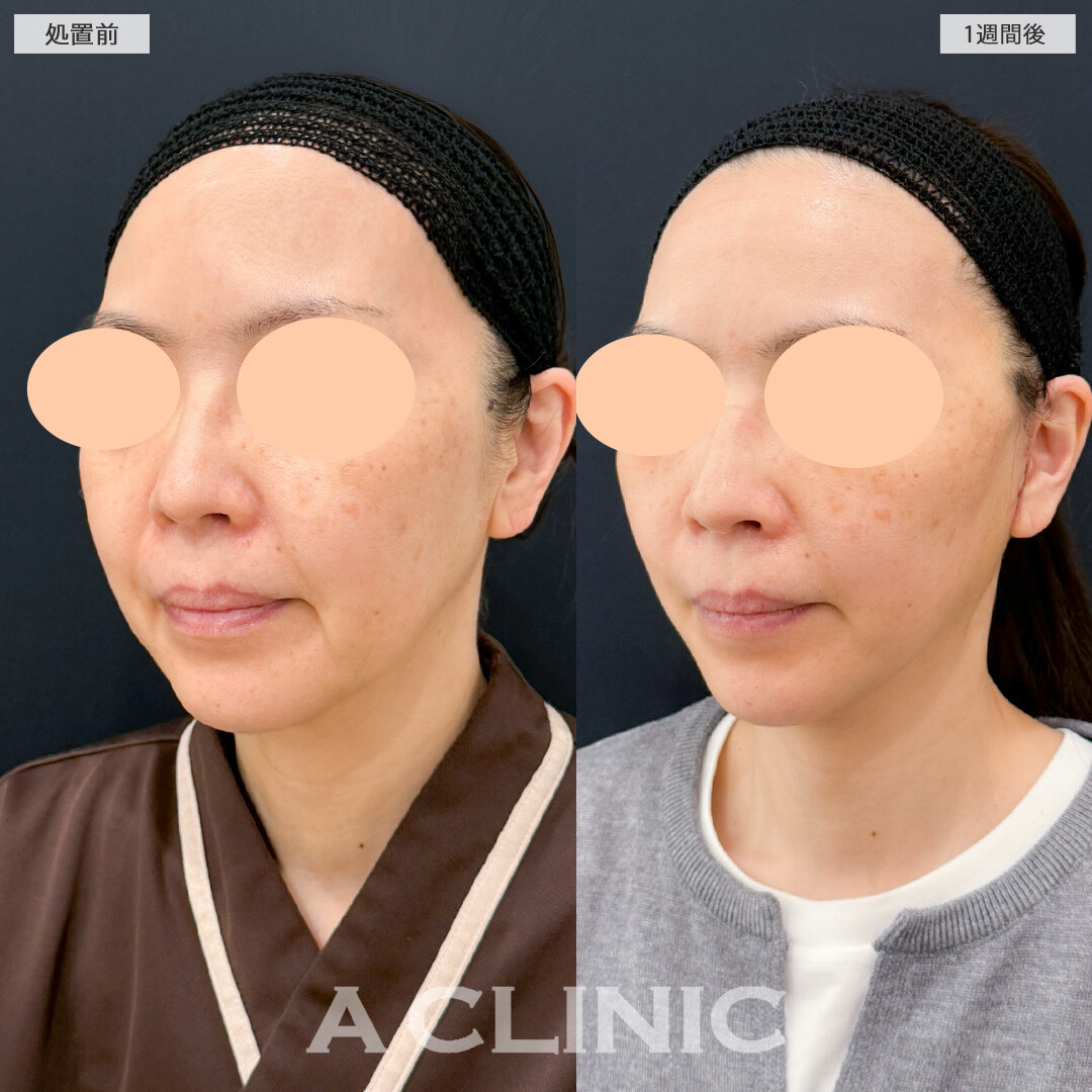 A式美肌たるみ切開で年齢の出やすい口横やフェイスラインのもたつきがここまで変わりました！処置前と1週間後の症例です(40代女性)