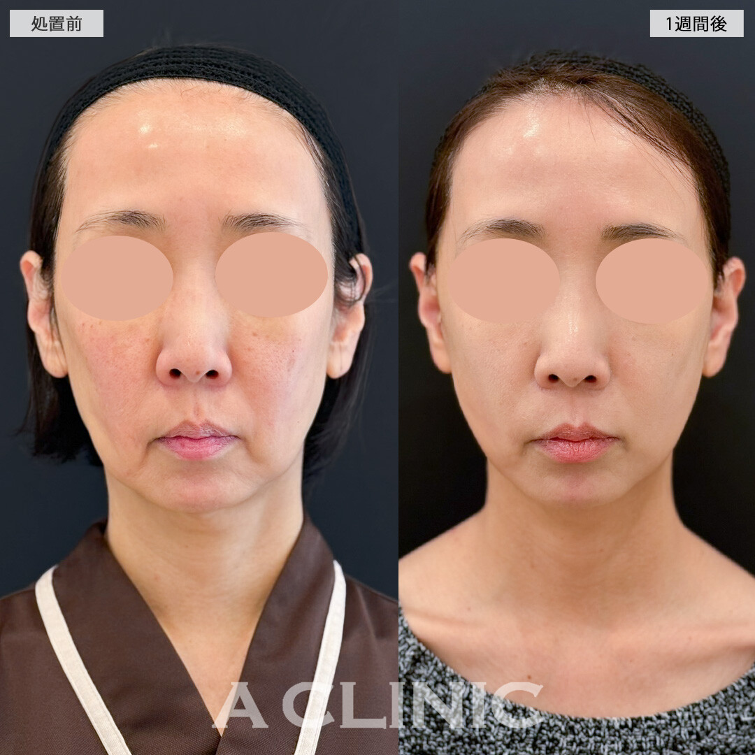 A式美肌たるみ切開で口元のたるみが減るだけでも一気に若く見えるようになります！処置前と1週間後の症例です(50代女性)