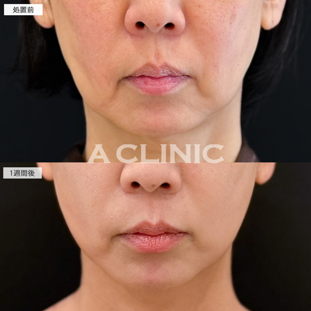 A式美肌たるみ切開で口元のたるみが減るだけでも一気に若く見えるようになります！処置前と1週間後の症例です(50代女性)