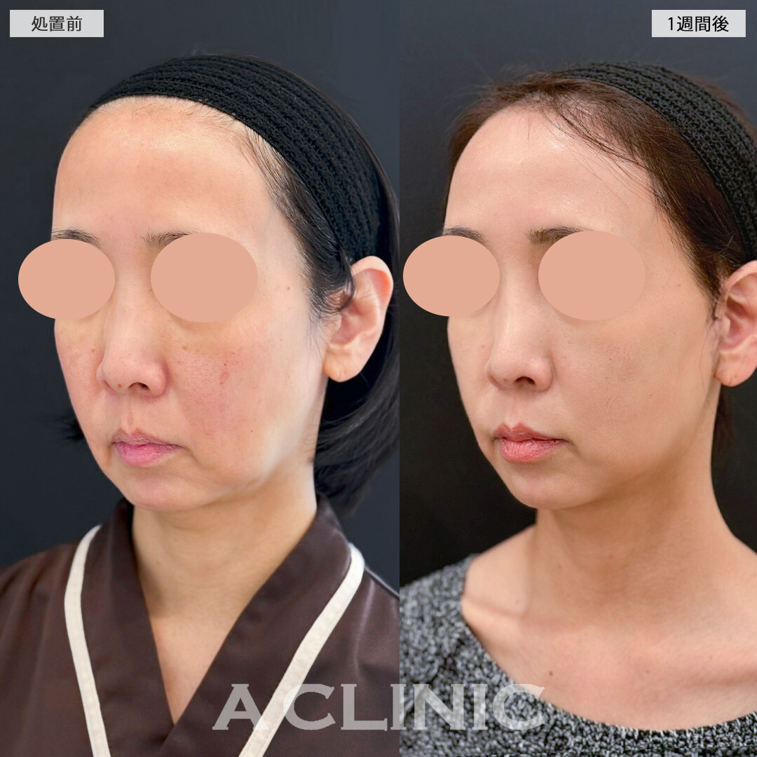 A式美肌たるみ切開で口元のたるみが減るだけでも一気に若く見えるようになります！処置前と1週間後の症例です(50代女性)