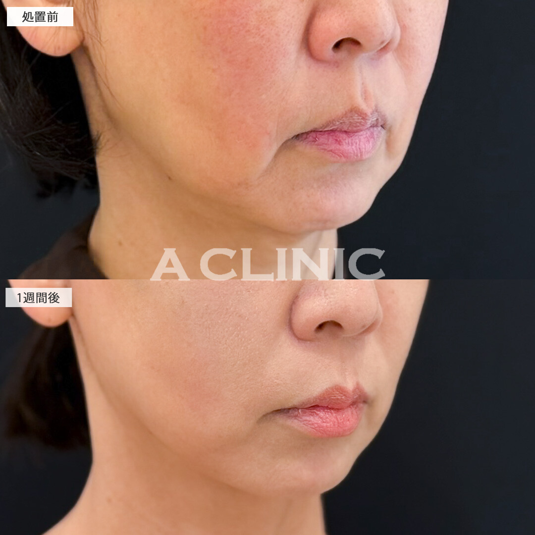 A式美肌たるみ切開で口元のたるみが減るだけでも一気に若く見えるようになります！処置前と1週間後の症例です(50代女性)