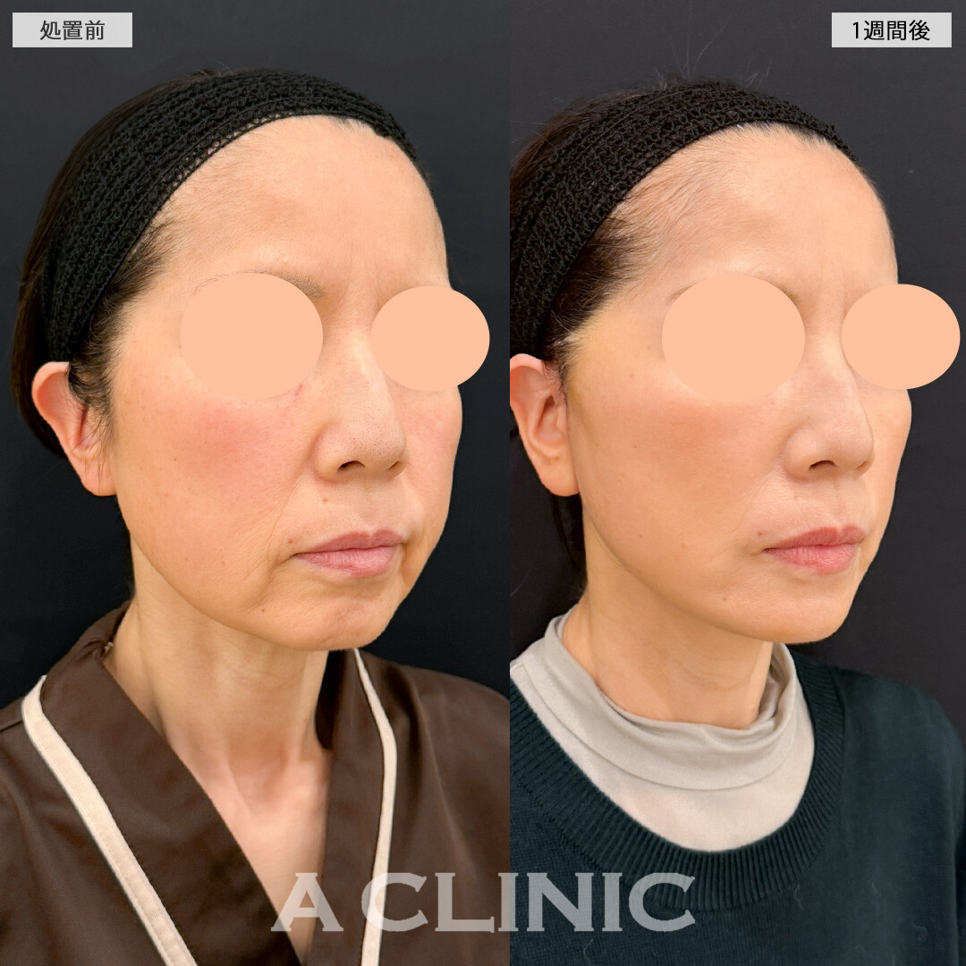 【直後の傷跡あり】A式美肌たるみ切開で口横のたるみが激減！処置前と1週間後の症例です(50代女性)