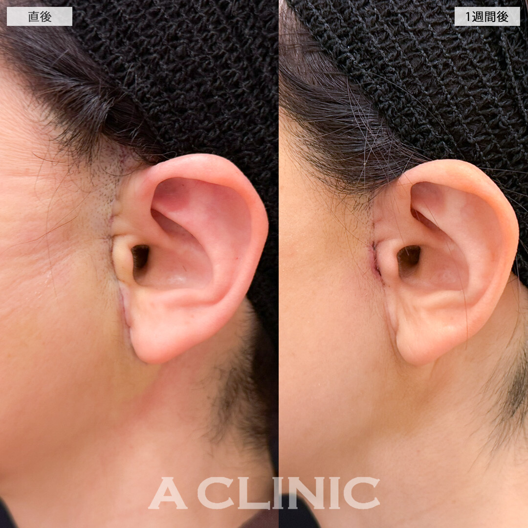 【直後の傷跡あり】A式美肌たるみ切開で口横のたるみが激減！処置前と1週間後の症例です(50代女性)