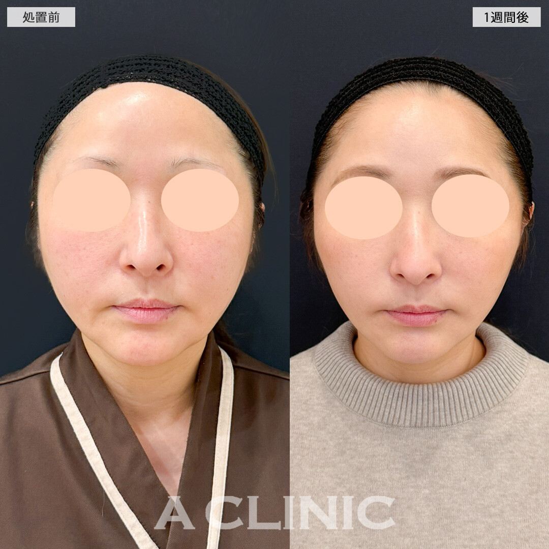 A式美肌たるみ切開でダウンタイムを最小限に抑えてさりげなく若返り！処置前と1週間後の症例です(40代女性)