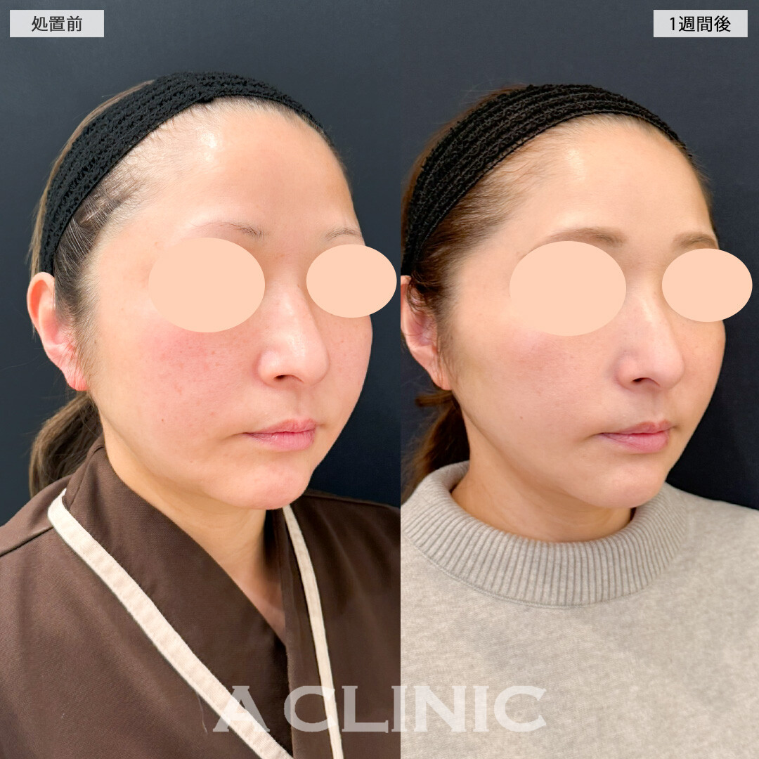 A式美肌たるみ切開でダウンタイムを最小限に抑えてさりげなく若返り！処置前と1週間後の症例です(40代女性)