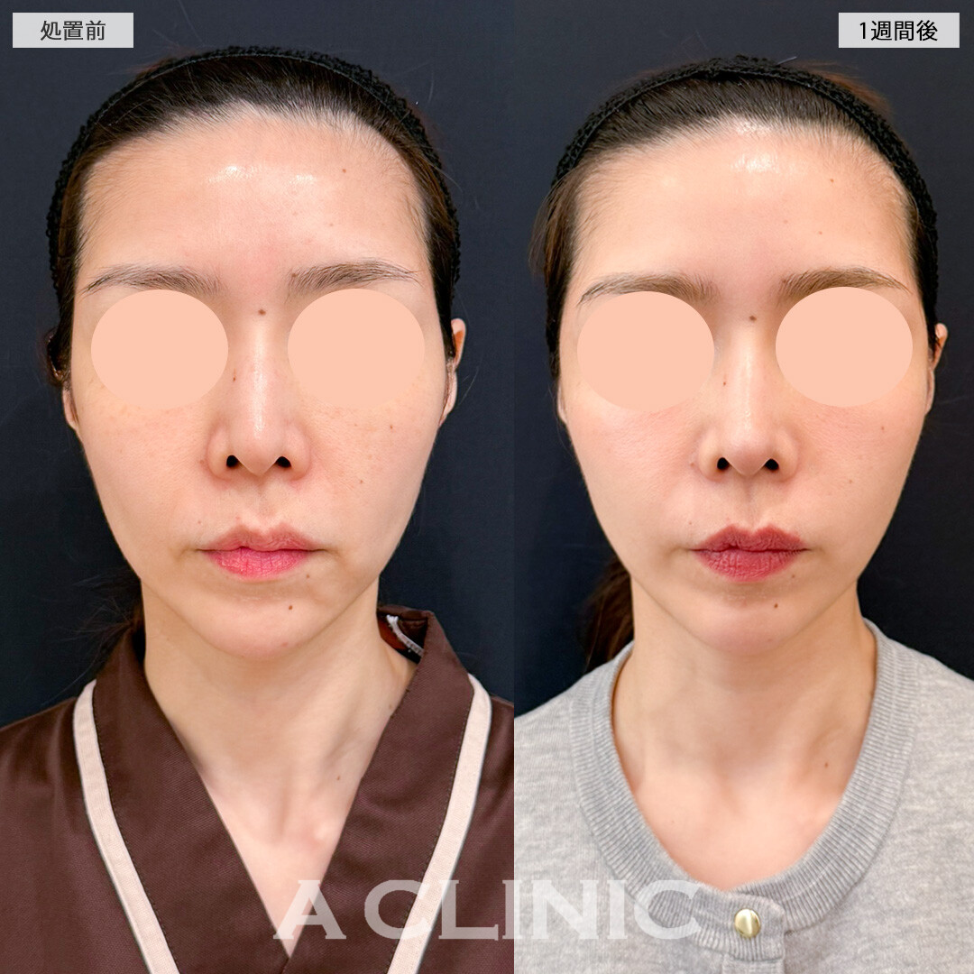 A式美肌たるみ切開で年齢の出やすいほうれい線にアプローチ！処置前と1週間後の症例です(40代女性)