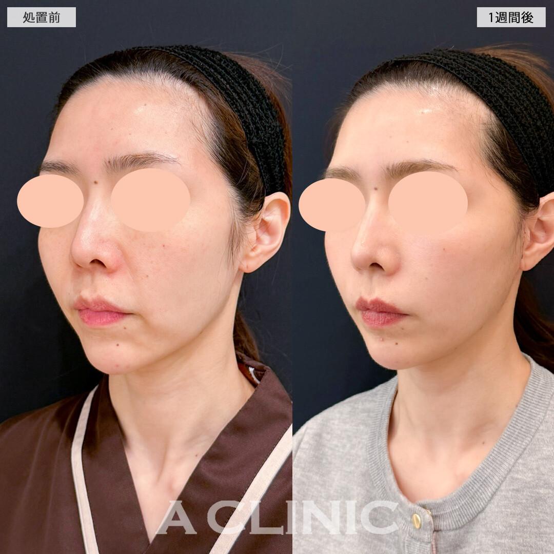 A式美肌たるみ切開で年齢の出やすいほうれい線にアプローチ！処置前と1週間後の症例です(40代女性)