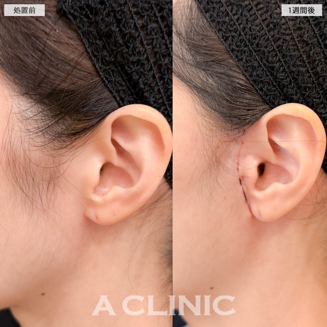 A式美肌たるみ切開で年齢の出やすいほうれい線にアプローチ！処置前と1週間後の症例です(40代女性)