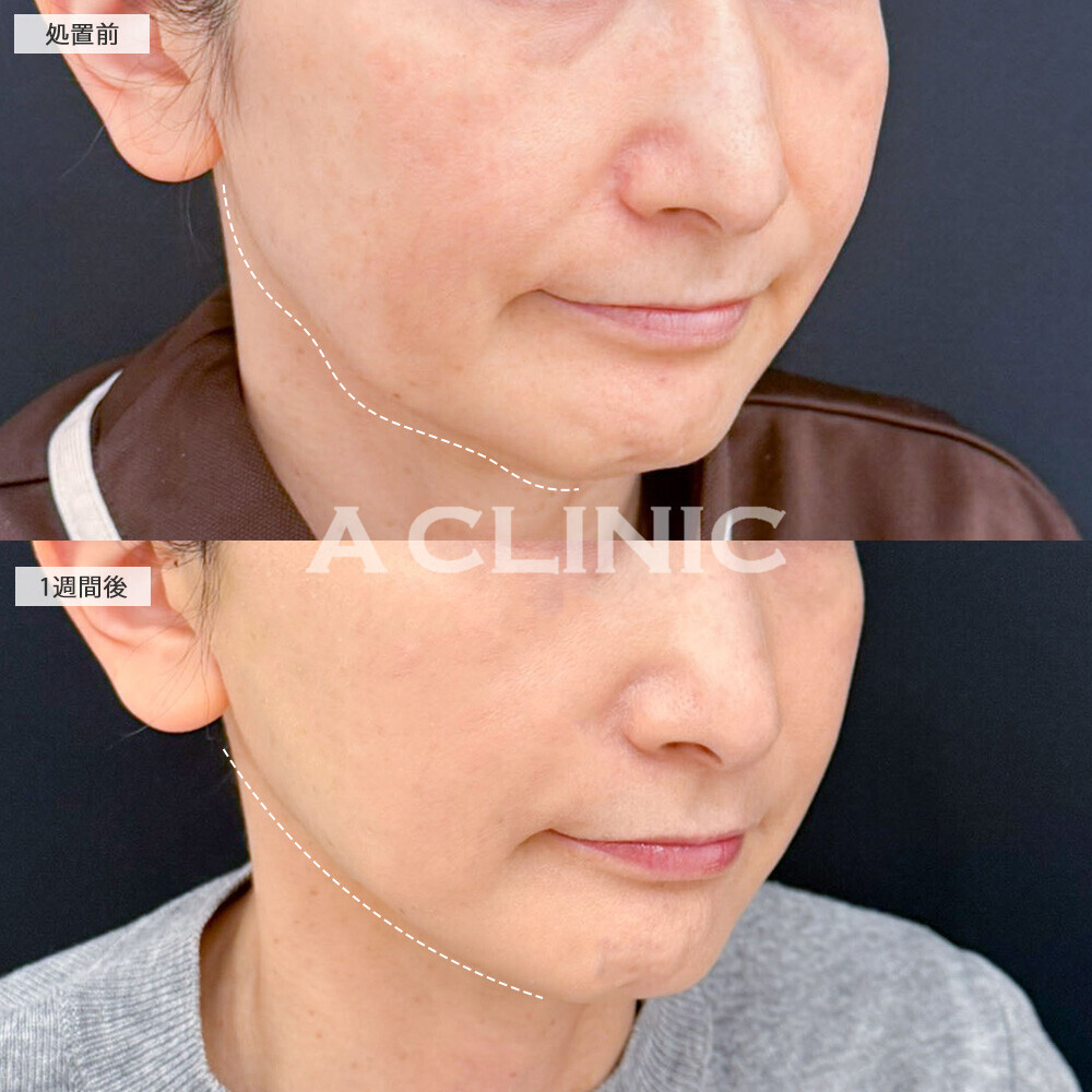 A式美肌たるみ切開なら術後1週間で10歳若見え！こちら処置前と1週間後の症例です(50代女性)
