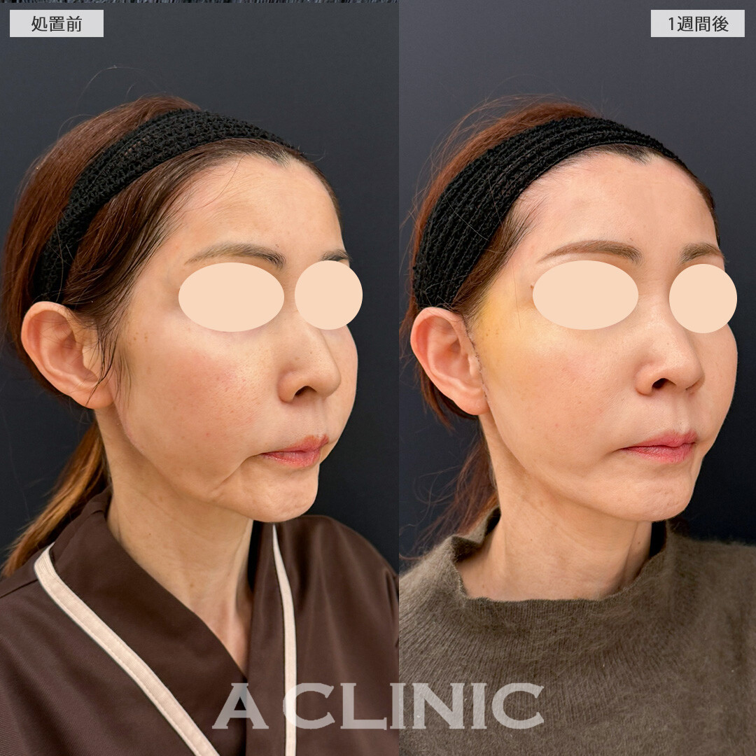 口横のたるみやほうれい線が改善されて若返りました！A式美肌たるみ切開の処置前と1週間後の症例です(50代女性)